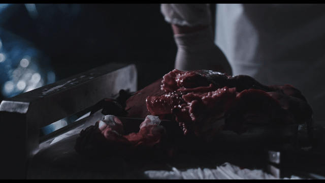Surgeon placing organ in dark operating room