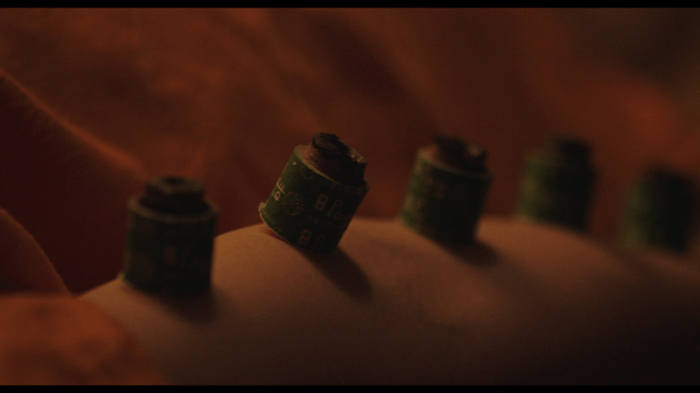 Traditional moxibustion treatment process