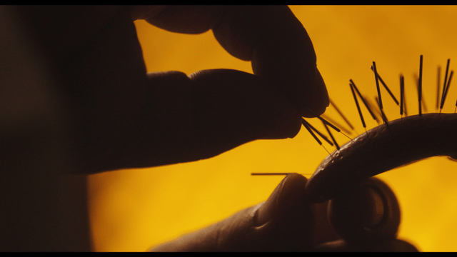 Acupuncture treatment in progress on tongue