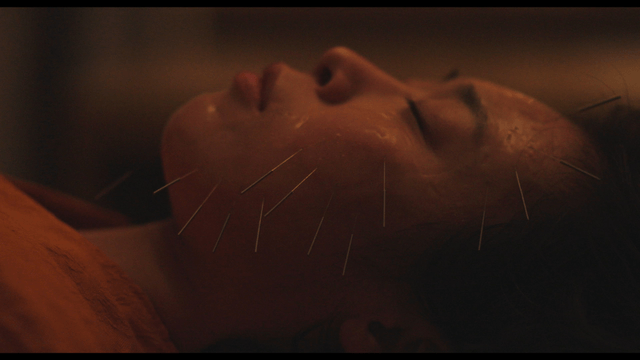 Woman receiving acupuncture treatment on face