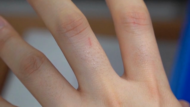 A wound on a finger