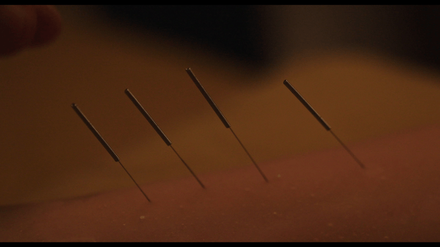 Acupuncture needles on skin